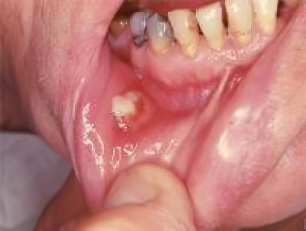 актиномикоз полости рта