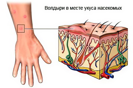 Аллергия на укусы комаров Аллергия на укусы комаров