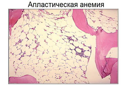 Апластическая анемия