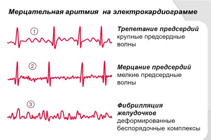 Виды мерцательной аритмии