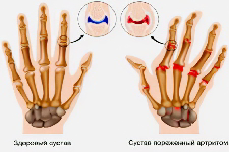 артрита пальцев рук