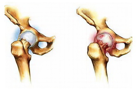 артрита тазобедренного сустава