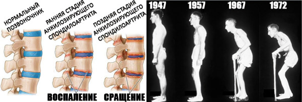 Спондилоартроз