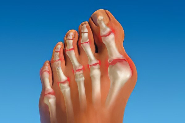 Симптомы артроза пальцев рук и ног
