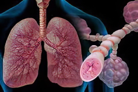 Аллергическая (атопическая) астма
