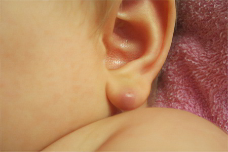 Атерома на мочке уха