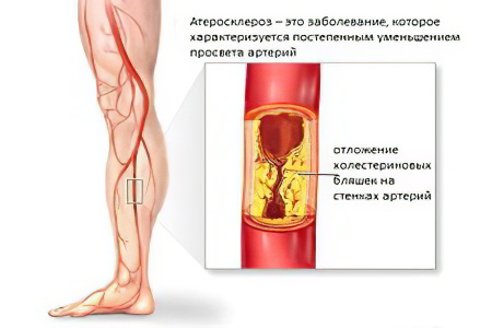 Причины атеросклероза