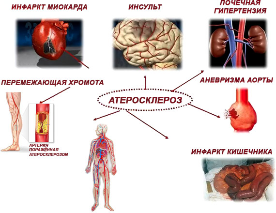 Чем опасен атеросклероз