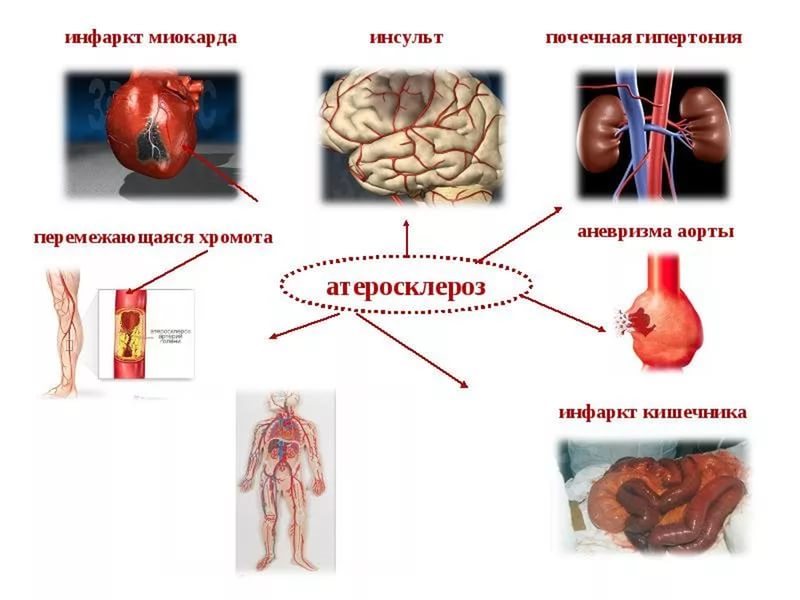 атеросклероз атеросклероз