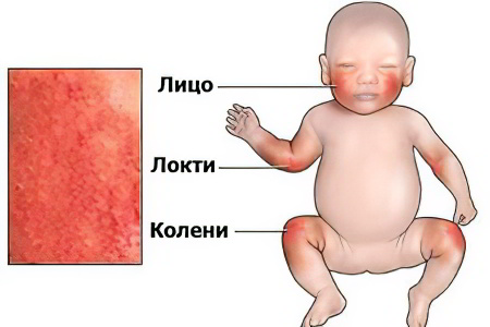 Атопический дерматит у детей