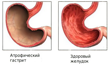 атрофический гастрит