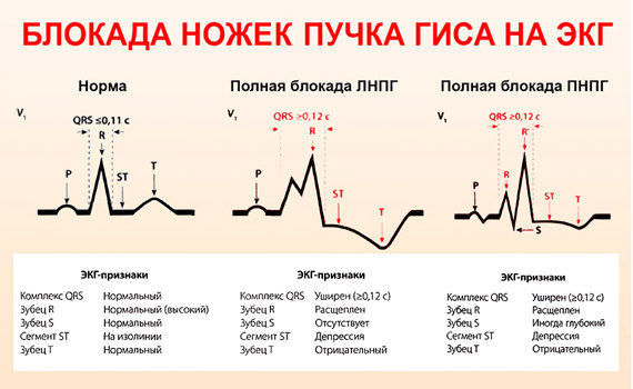 Симптомы блокады пучка Гиса