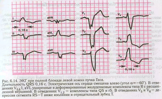 Блокада левой ножки пучка Гиса