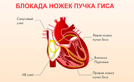 Что такое блокада ножек пучка Гиса