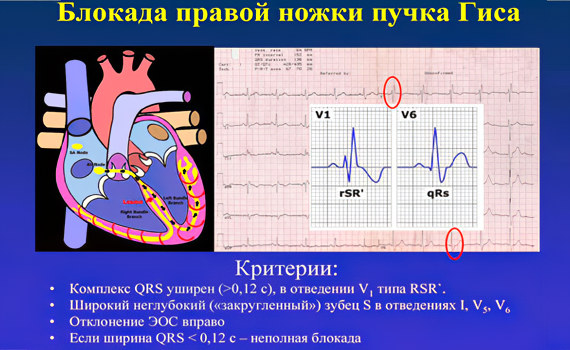 Блокада правой ножки пучка Гиса