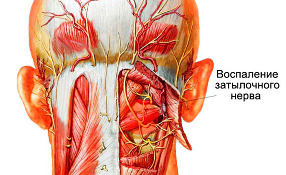 Невралгия затылочного нерва