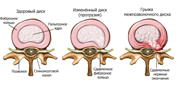 Грыжа межпозвоночного диска