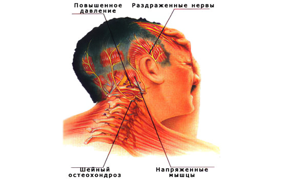 Мигрень и цервикогенные боли