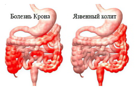 Болезнь Крона