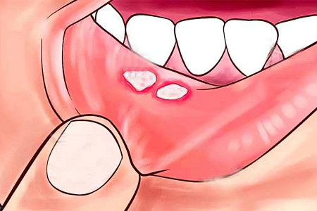 Болезни полости рта и зубов