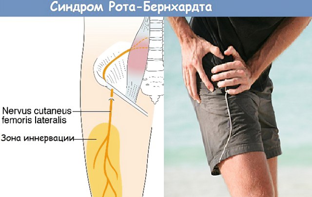 Болезнь Рота-Бернгардта