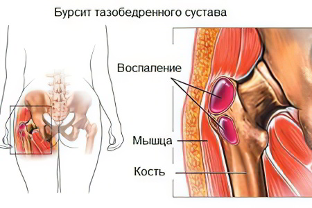 Бурсит тазобедренного сустава