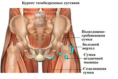 бурсит