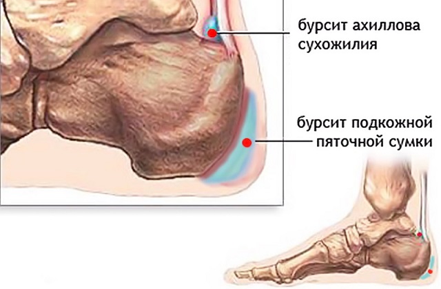 Бурсит пятки