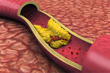Чем опасен повышенный холестерин?