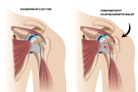 Плечелопаточный периартрит