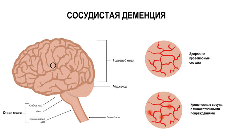 Что такое деменция