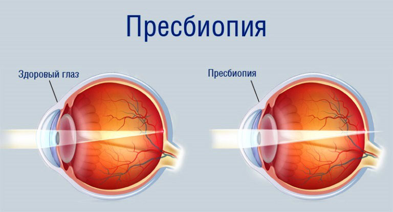 Что такое пресбиопия Что такое пресбиопия