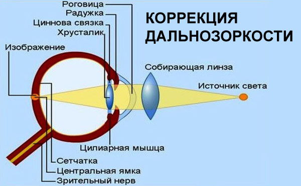 Оптическая коррекция зрения