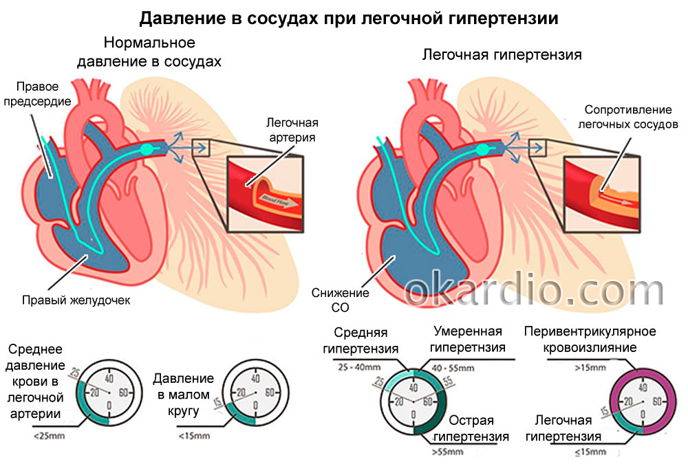 Причины лёгочной гипертензии