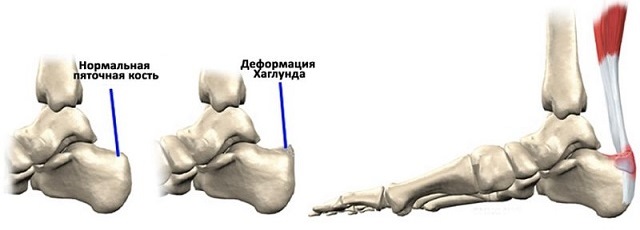 Деформация Хаглунда