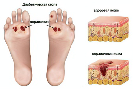 Диабетическая стопа