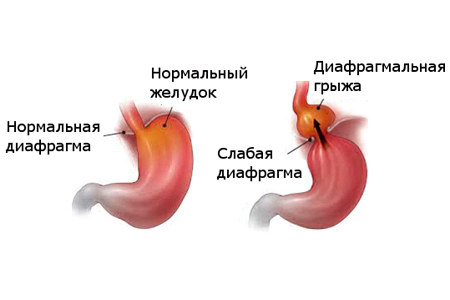 Диафрагмальная грыжа