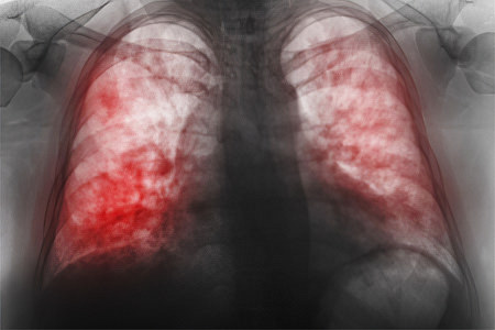 Двусторонняя пневмония лёгких