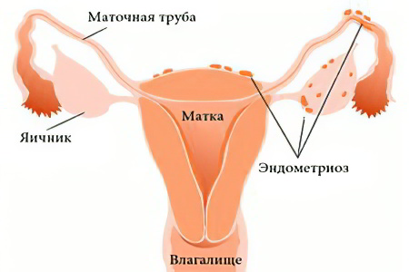 Эндометриоз Эндометриоз