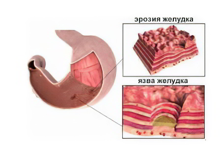 эрозивный гастрит