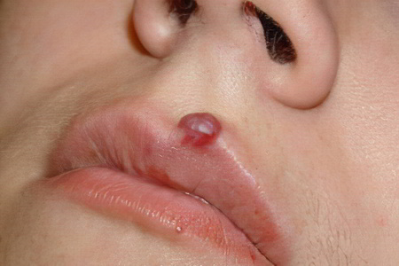 Фиброма губы