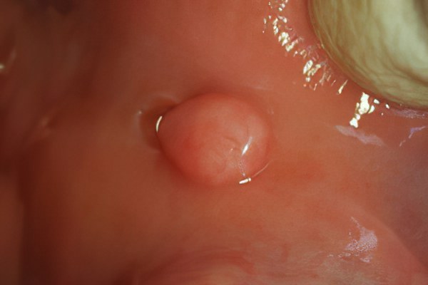 Фиброма полости рта
