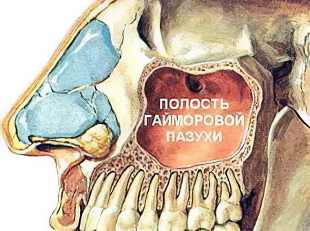 Корни Зуба В Гайморовой Пазухе Шум В Ушах