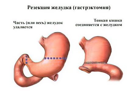 Гастроэктомия