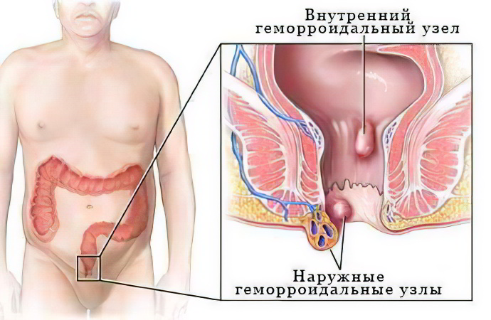 5 тревожных симптомов геморроя