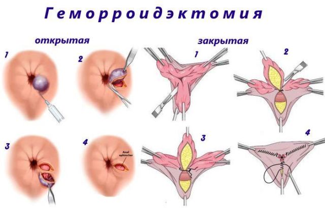 Тромбэктомия геморроидального узла