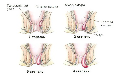 Как лечить геморрой у женщин