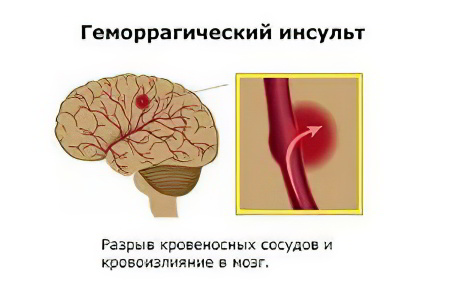 Геморрагический инсульт