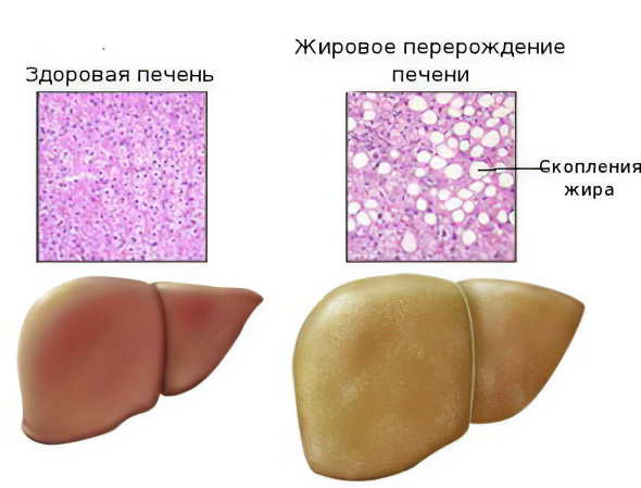 Гепатоз печени