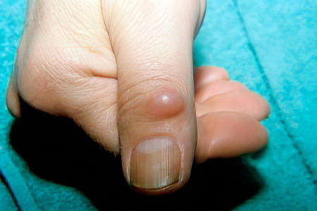 Гигрома пальца руки: лечение, причины и симптомы